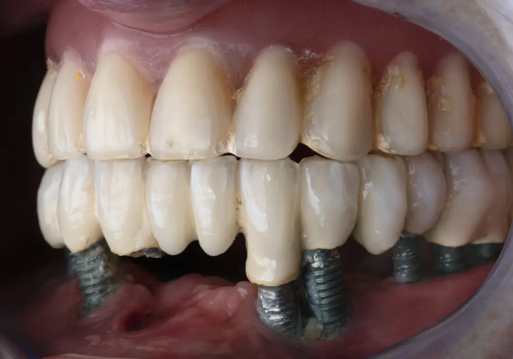 All on Four Implant