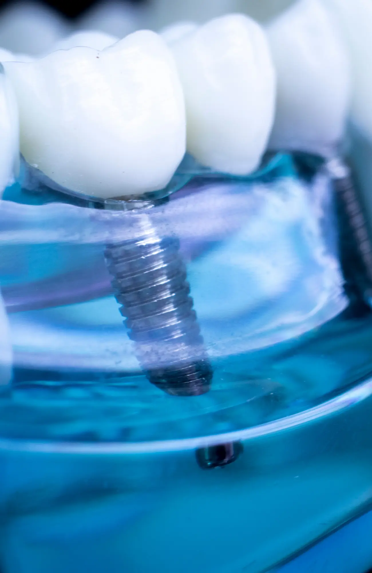 dental-implant (8)