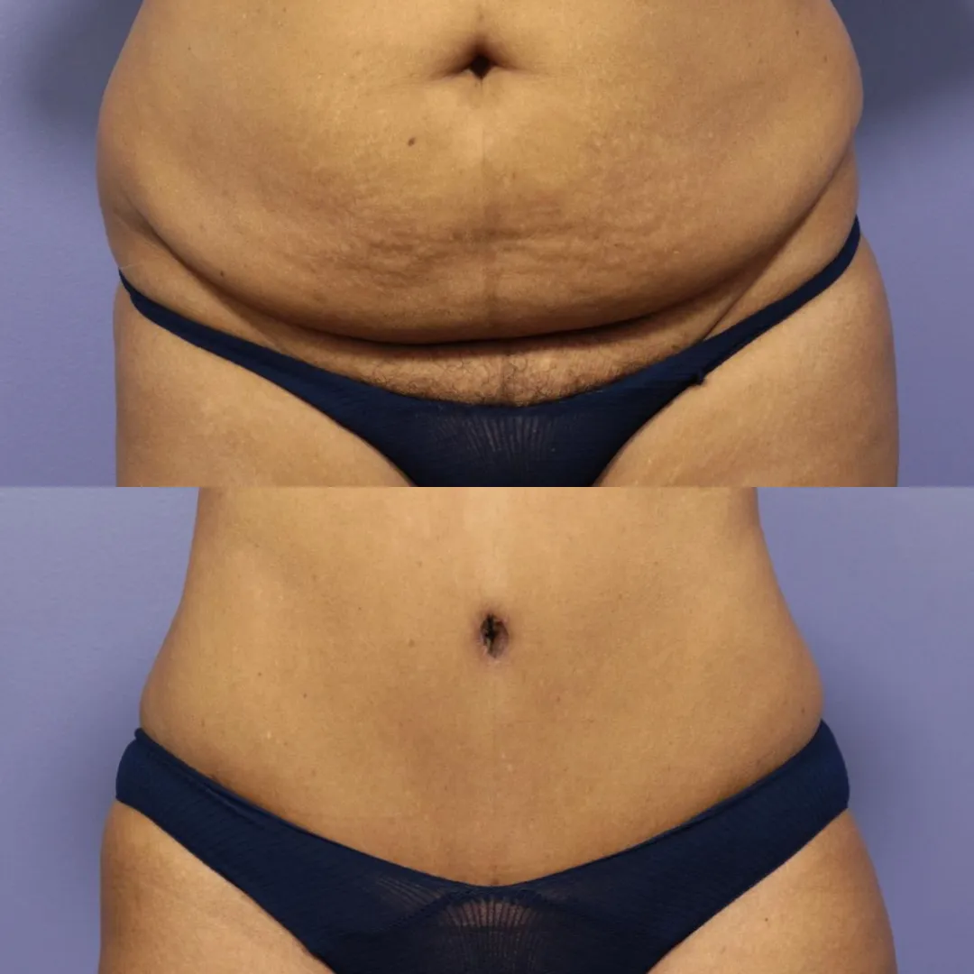 Abdominoplasty Surgery - Tummy Tuck in Newfoundland, Canada