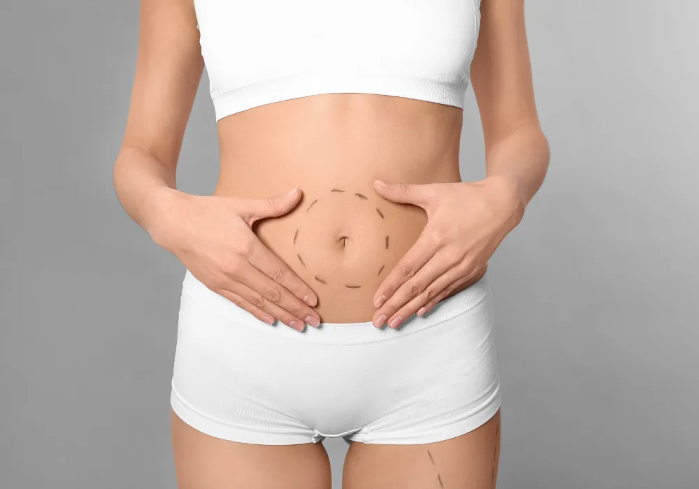 Tummy Tuck With 360 Liposuction
